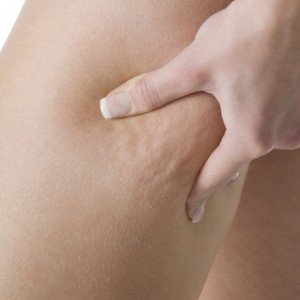 Get Rid of Cellulite Overland Park